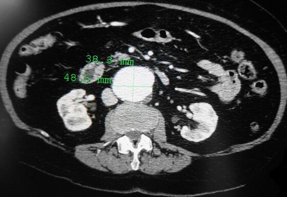 Abdominal aortic aneurysm — dilated aorta on contrast CT