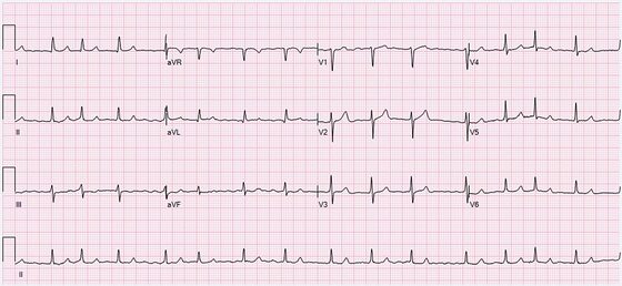 Atrial fibrillation — irregularly irregular rhythm with absent P waves (ECG)