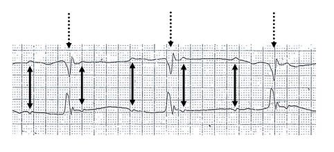 Complete (third-degree) AV block — P waves and QRS dissociated (ECG)