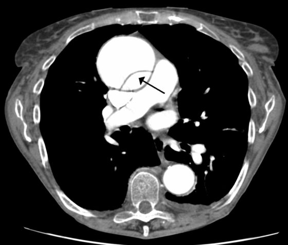 Aortic dissection — intimal flap on contrast-enhanced CT