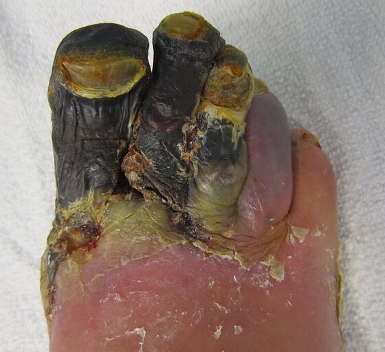 Gangrene of the foot — necrotic, blackened tissue