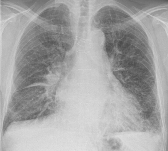 Pulmonary oedema — Kerley B lines and interstitial shadowing (chest X-ray)