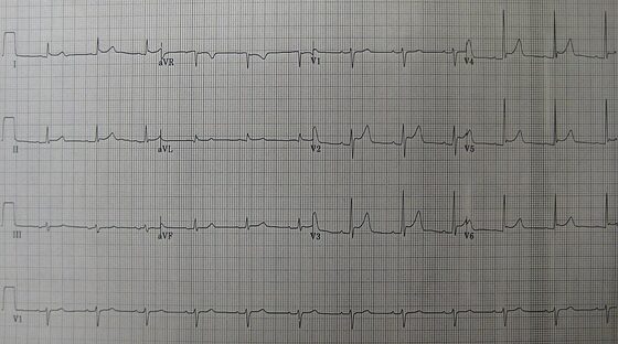 Acute pericarditis — widespread saddle-shaped ST elevation with PR depression (ECG)