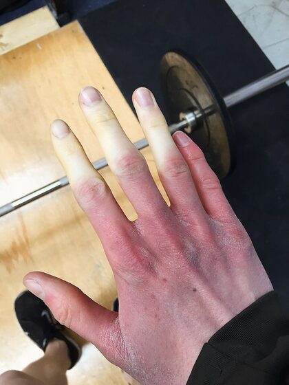 Raynaud's phenomenon — demarcated pallor of the digits