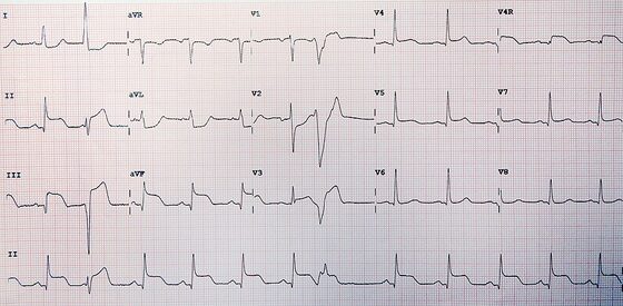 STEMI — ST-segment elevation on the 12-lead ECG