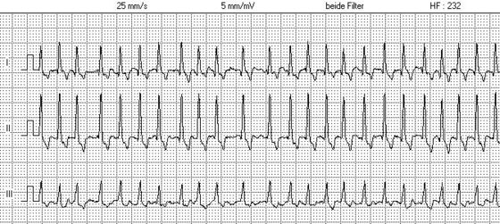SVT — regular narrow-complex tachycardia (ECG)