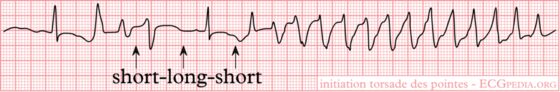 Torsades de pointes — polymorphic VT with a twisting axis (rhythm strip)