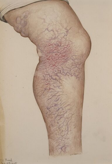 Varicose veins with chronic venous skin changes of the lower leg