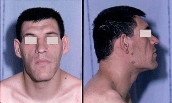 Acromegaly — coarse facial features and prognathism