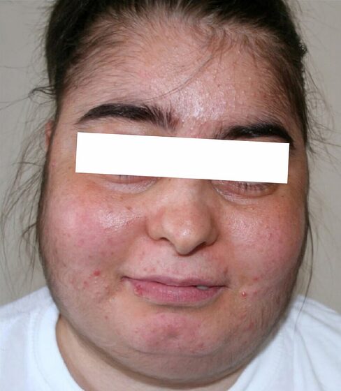 Cushingoid features — moon face / central adiposity