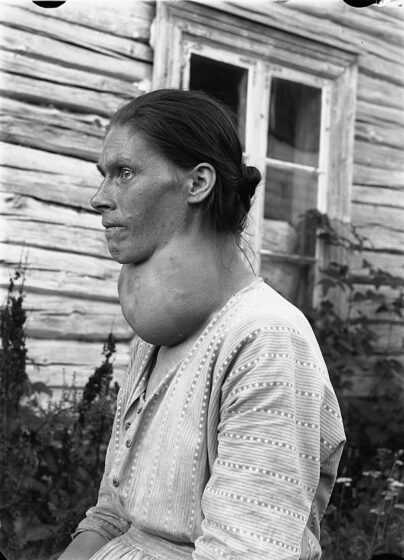 Goitre — visible thyroid enlargement