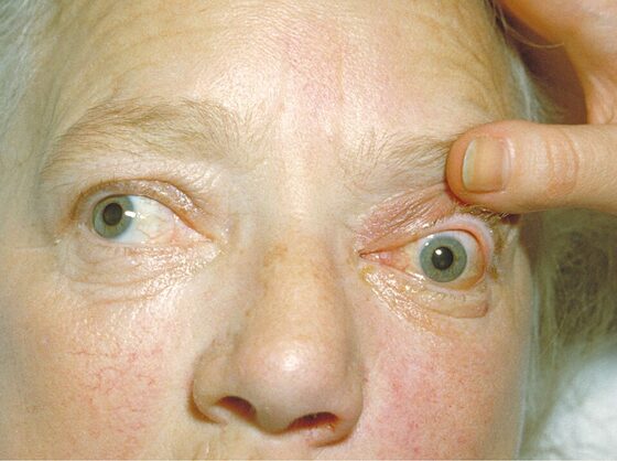 Graves' disease — exophthalmos and goitre