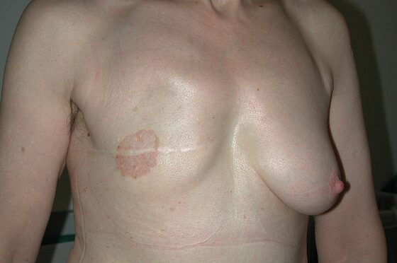 Paget's disease of the nipple — eczema-like nipple change