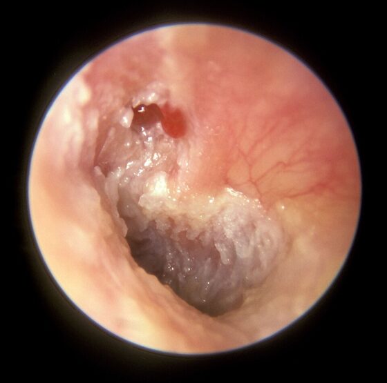 Attic cholesteatoma — squamous debris