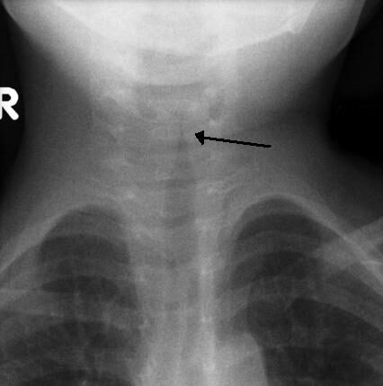 Croup — AP neck X-ray "steeple sign"