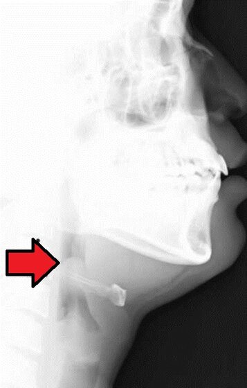 Epiglottitis — lateral neck "thumbprint" sign