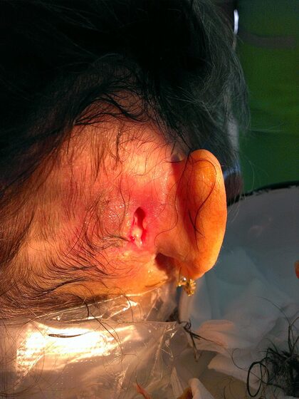 Mastoiditis — postauricular swelling, protruding pinna