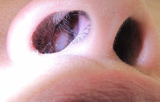 Nasal polyp — pale, in the nasal cavity
