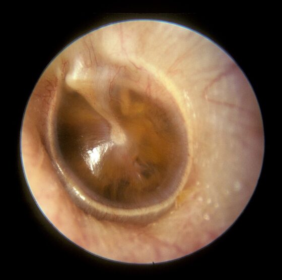 OME — dull retracted drum with effusion