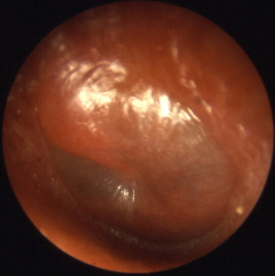 Acute otitis media — red, bulging eardrum