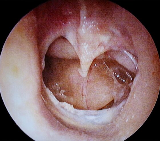 Perforated tympanic membrane