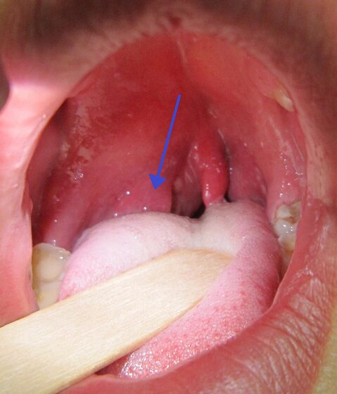 Quinsy — peritonsillar swelling, uvular deviation
