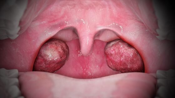 Acute tonsillitis — erythema and exudate