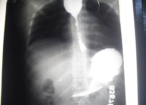 'Apple-core' irregular shouldered stricture on contrast swallow — malignant oesophageal stricture