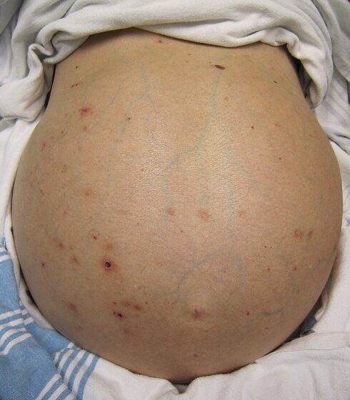 Decompensated cirrhosis — gross ascites with distended abdomen (and caput medusae)