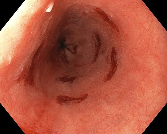 Barrett oesophagus — salmon-pink columnar metaplasia at the lower oesophagus (endoscopy)