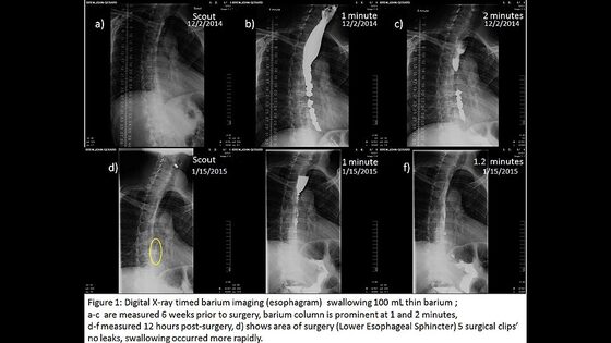 Achalasia — dilated oesophagus tapering to a smooth 'bird-beak' (contrast swallow)