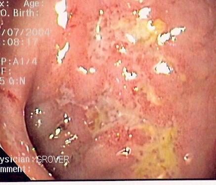 Crohn disease — cobblestoning/deep ulceration of the bowel mucosa (endoscopy)
