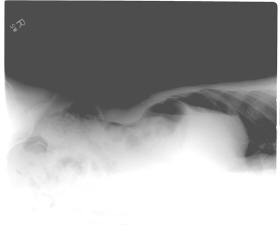 Pneumoperitoneum — free gas under the diaphragm on an erect chest X-ray (perforation)
