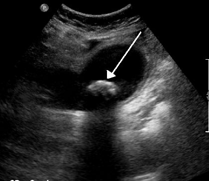 Gallstone on ultrasound — echogenic focus with posterior acoustic shadowing