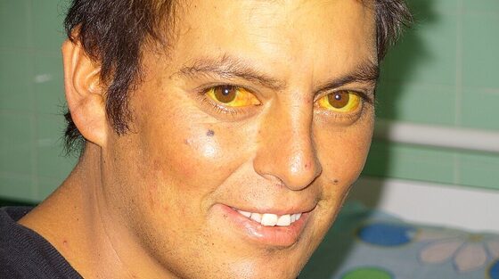 Jaundice — scleral icterus (yellow sclerae) of liver disease