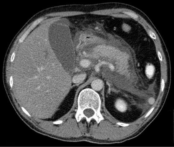 Acute pancreatitis — oedematous pancreas with peripancreatic fluid/inflammation (CT)