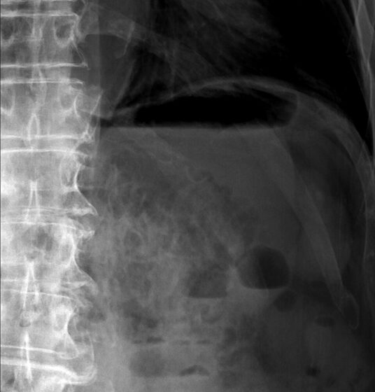 Necrotising enterocolitis — pneumatosis intestinalis (intramural gas) on neonatal AXR