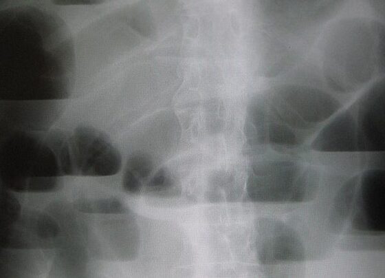 Small-bowel obstruction — dilated central loops with valvulae conniventes crossing the full width (AXR)