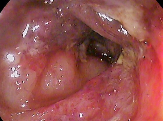 Ischaemic colitis — mucosal oedema 'thumbprinting' of the colon (AXR/contrast)