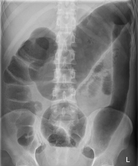 Toxic megacolon — dilated transverse colon (>6 cm) with mucosal oedema (AXR)