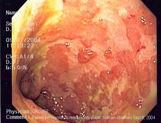 Ulcerative colitis — continuous granular, friable, ulcerated mucosa (endoscopy)