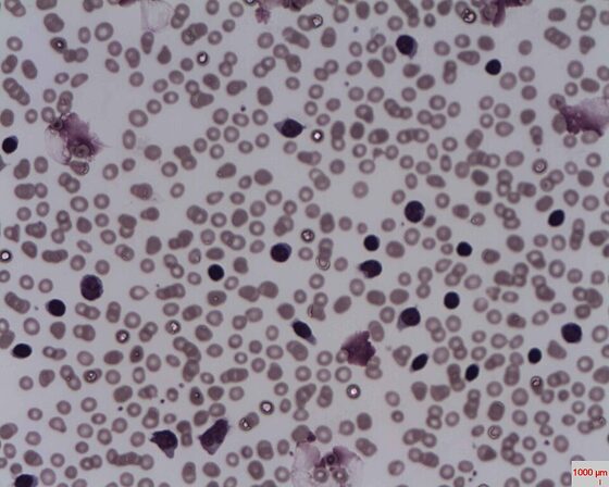 CLL — lymphocytosis with smear (smudge) cells (blood film)