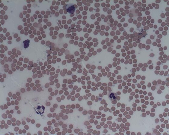 Howell-Jolly bodies (nuclear remnants) of hyposplenism (blood film)