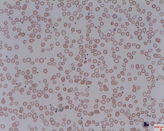 Iron-deficiency anaemia — hypochromic microcytic red cells (blood film)