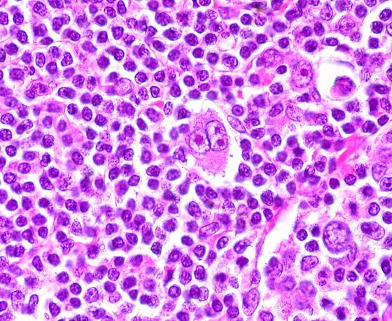 Reed-Sternberg cell in Hodgkin lymphoma (histology)