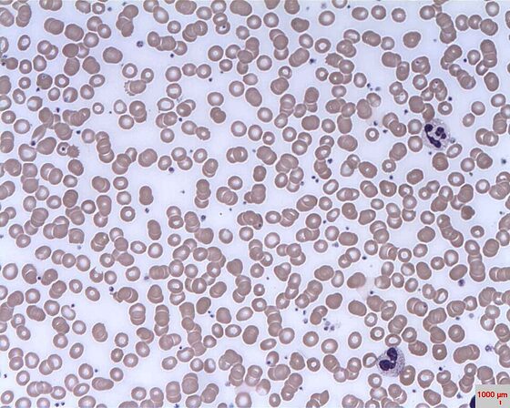 Rouleaux formation (stacked red cells) in myeloma (blood film)