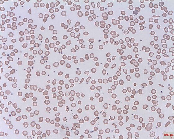 Schistocytes (red-cell fragments) — microangiopathic haemolysis (blood film)