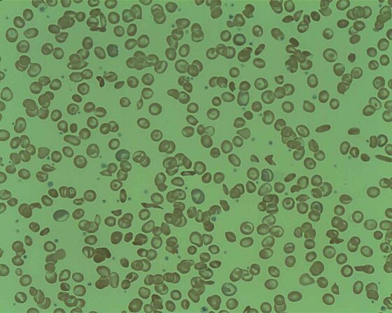 Sickle cell disease — sickled red cells on the blood film