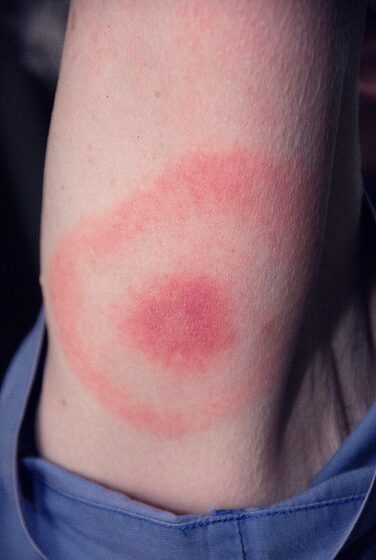 Erythema migrans — the 'bull's-eye' rash of Lyme disease