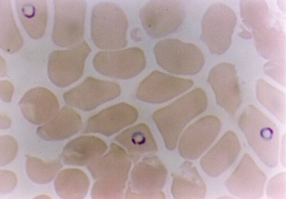 Plasmodium falciparum within red blood cells (blood film)